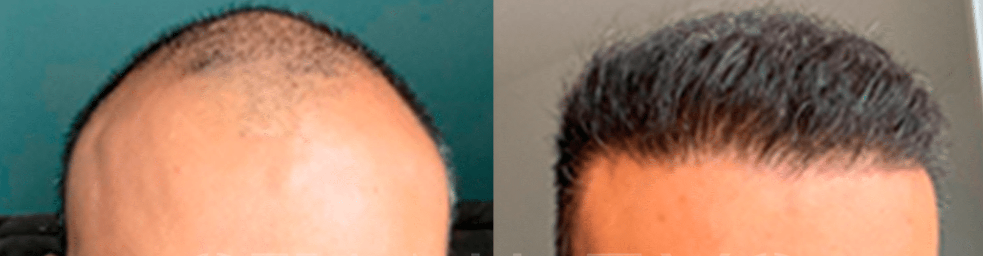 Transformação capilar: antes e depois do implante