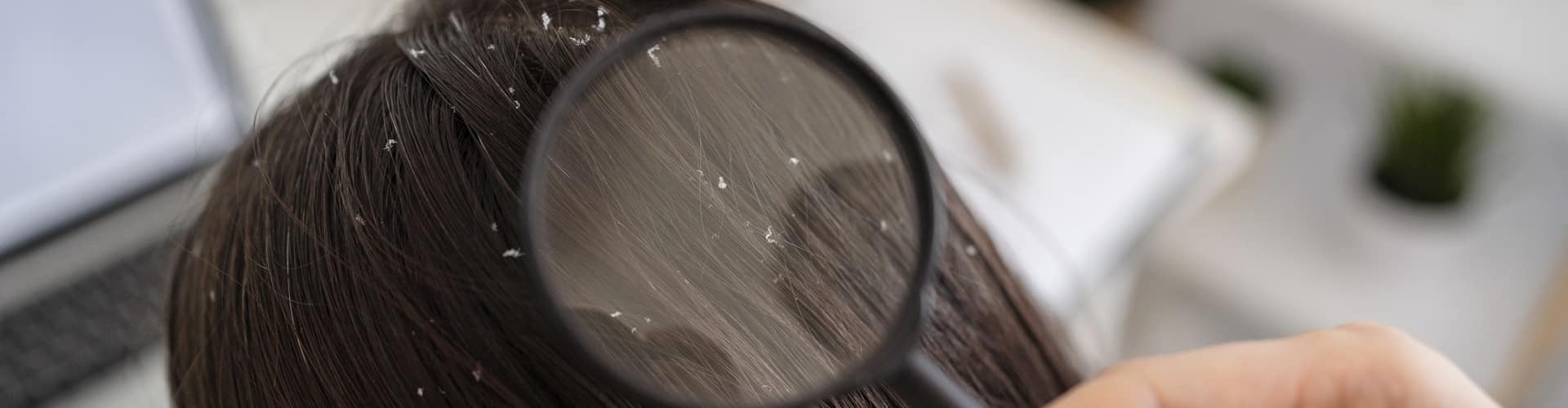 Conheça as doenças capilares que causam queda de cabelo