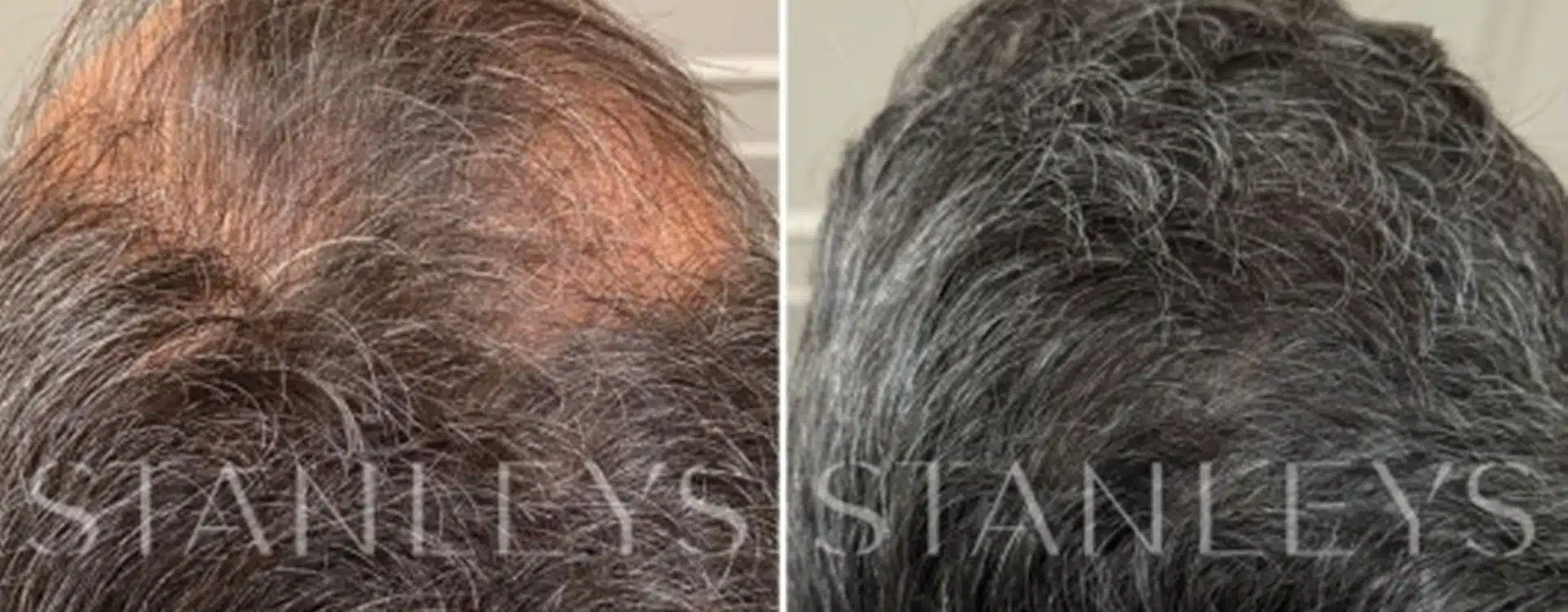 Saiba quanto tempo o implante capilar dura