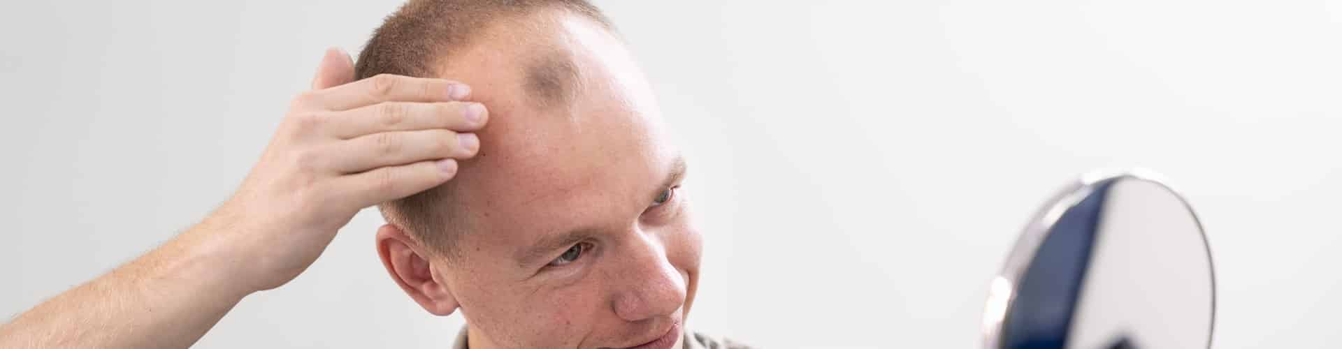 Entenda o que é alopecia androgenetica e saiba como tratar