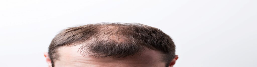 Desvendando a Alopecia Traumática: Causas e Implicações