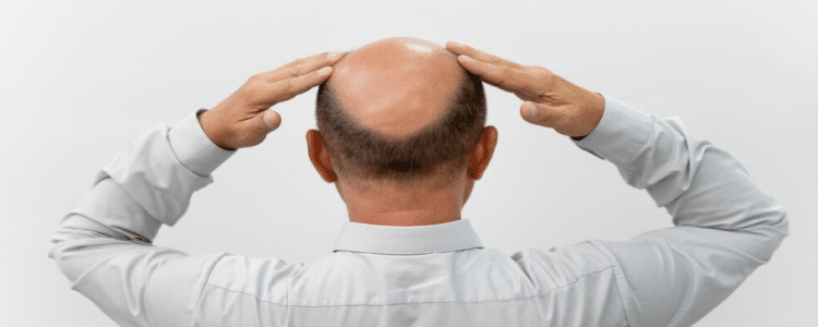 Alopecia Cicatricial: Causas, Sintomas e Como Reconhecer a Condição