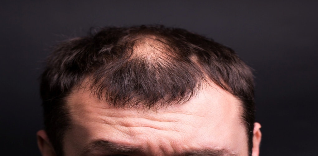 Alopecia frontal, conheça