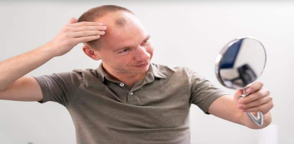 tipos de alopecia masculina