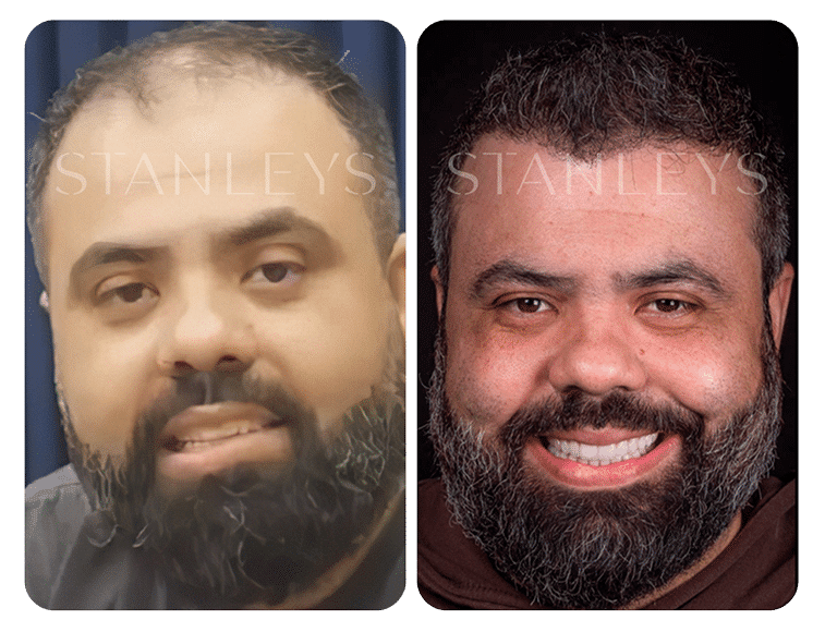 Antes-e-Depois_LP-19-1.png
