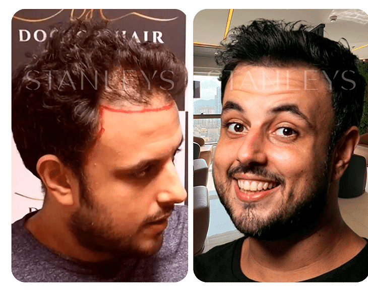 Antes-e-Depois_LP-21.png
