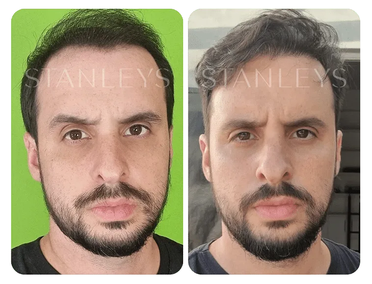 Antes-e-Depois_LP-22.png