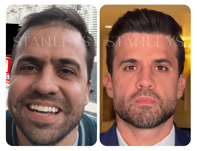 Antes-e-Depois_LP-23-1.png