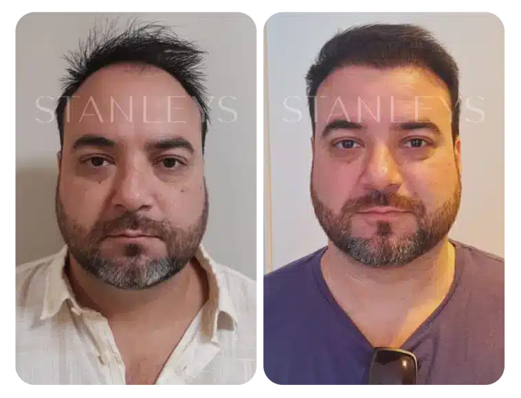 antes_e_depois_lp_01_1_2x.webp