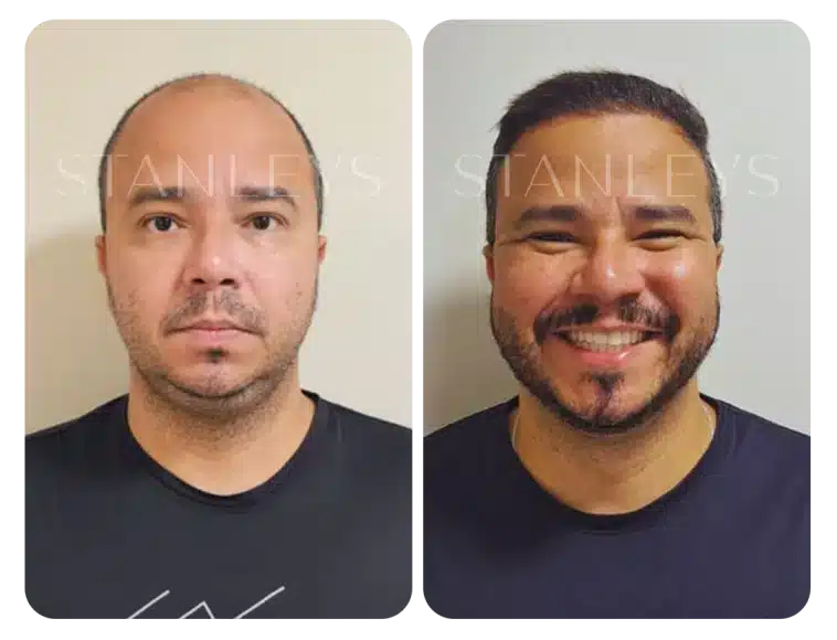 antes_e_depois_lp_03_2x.webp