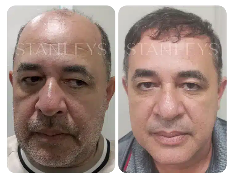antes_e_depois_lp_08_2x.webp