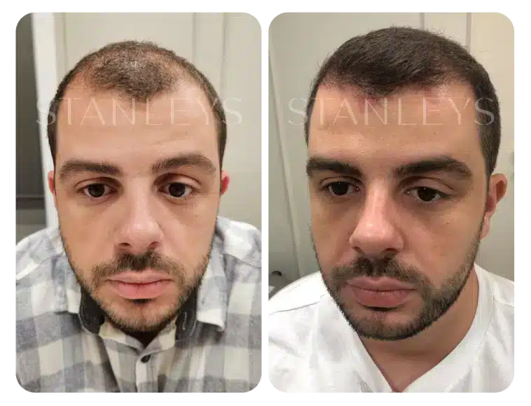 antes_e_depois_lp_10_2x.webp